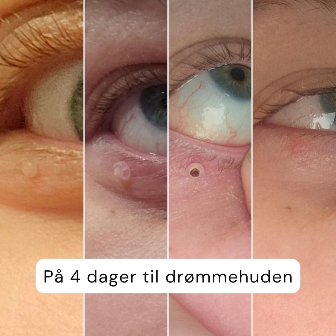 DermClear Sett mot Hudfliker