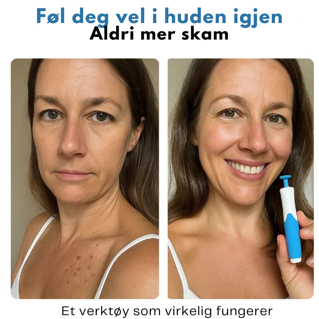 DermClear Sett mot Hudfliker