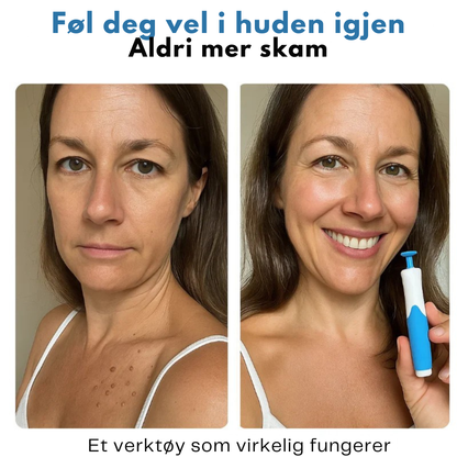DermClear Sett mot Hudfliker